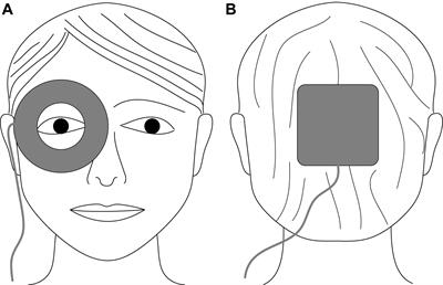 Pulsed Electrical Stimulation of the Human Eye Enhances Retinal Vessel Reaction to Flickering Light